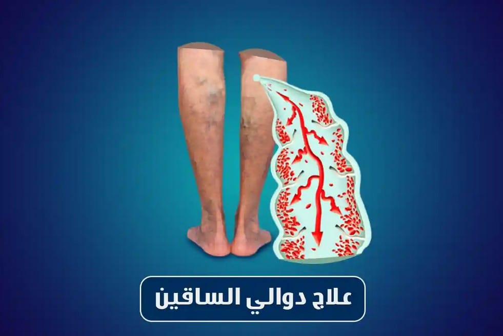 افضل دكتور جراحة اوعية دموية في مصر