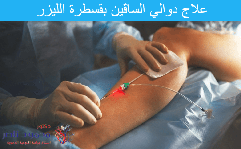 علاج دوالي الساقين بالليزر