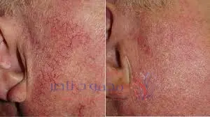 علاج الشعيرات الدموية في الوجه